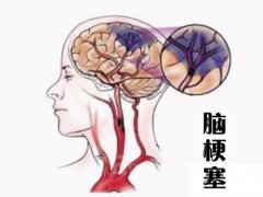 養(yǎng)成好的生活習(xí)慣，能夠有效預(yù)防腦梗塞